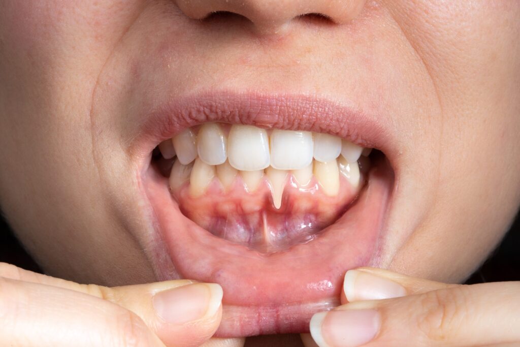 Preparing for teeth whitening with receding gums Loughborough